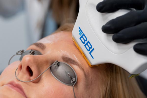 Broad Band Light (BBL) Photofacial - Dakka Aesthetics